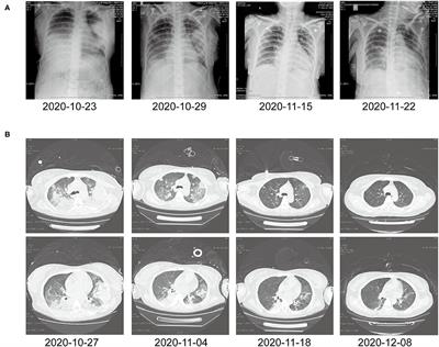 Gestational Psittacosis With Secondary Hemophagocytic Syndrome: A Case Report and Literature Review